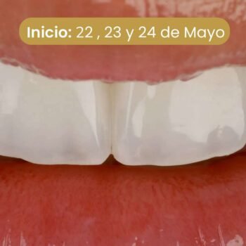 Planificación y Carillas Directas de Resinas (Curso Intensivo con pacientes en vivo)